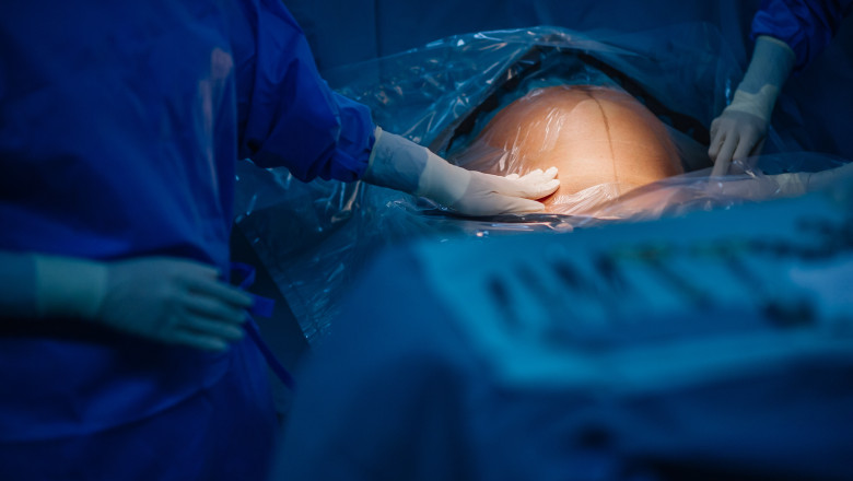 turcia interzice nasterile prin cezariana in clinici private regimul erdogan vorbeste despre nevoia de crestere a natalitatii 6807b3a4c0aba