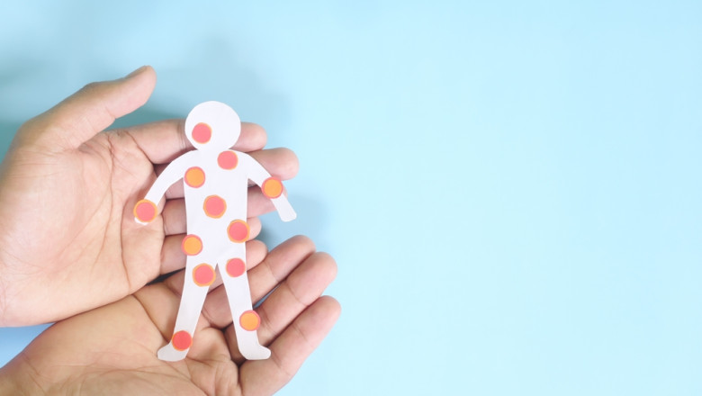 focar de rujeola in israel numarul cazurilor a ajuns la 48 majoritatea fiind copii nevaccinati 682611e0123c5