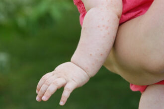 sua se confrunta cu cea mai grava epidemie de rujeola din secolul xxi secretarul de stat robert kennedy jr acuzat ca o alimenteaza 686c12fae65db