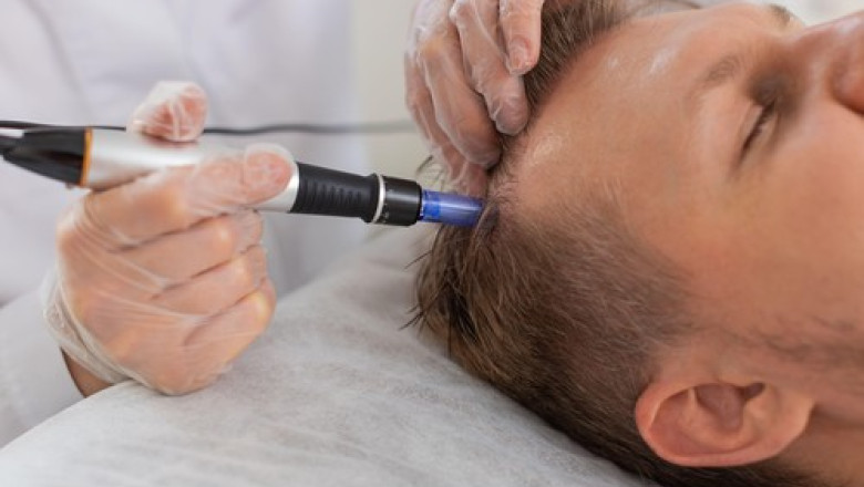 un barbat in varsta de 38 de ani a murit in timpul unei proceduri de transplant de par in turcia 688f972bbefdc