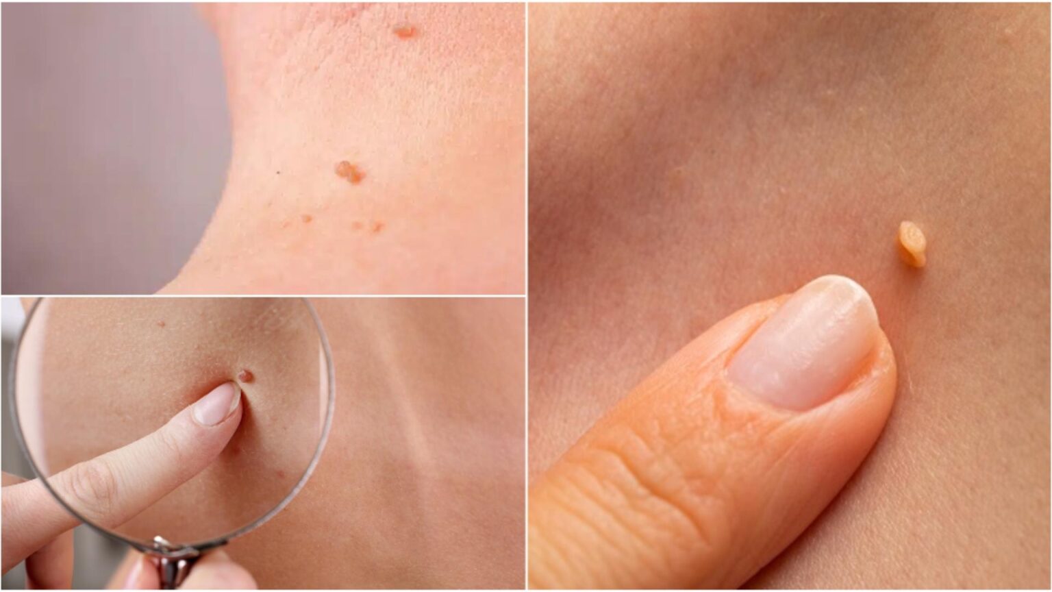 ce sunt papiloamele si cat de periculoase pot fi iata cum poti scapa de ele 68c9b3a89c441