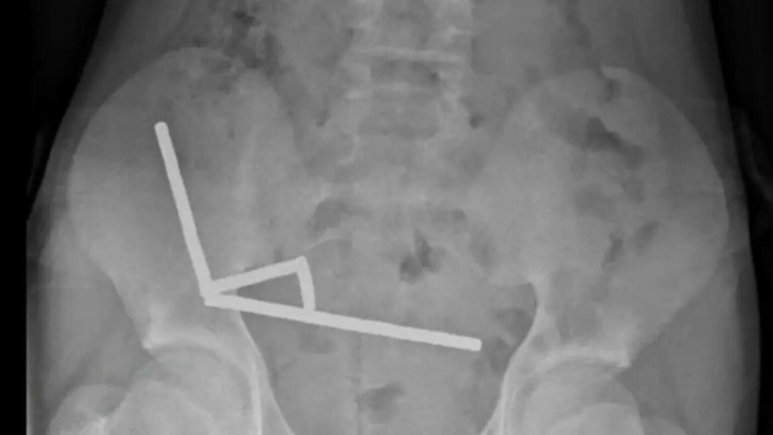 caz socant un baiat de 13 ani operat de urgenta dupa ce a inghitit aproape 200 de magneti 68fd02af4f714