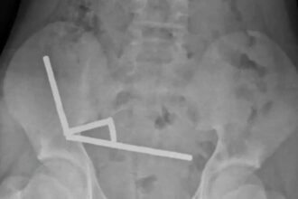 caz socant un baiat de 13 ani operat de urgenta dupa ce a inghitit aproape 200 de magneti 68fd02af4f714