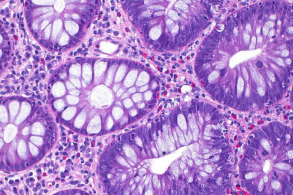 cum a ajuns cancerul de colon sa afecteze tot mai multi tineri si care este cauza principala indicata de studii 68e61cee6d9c8