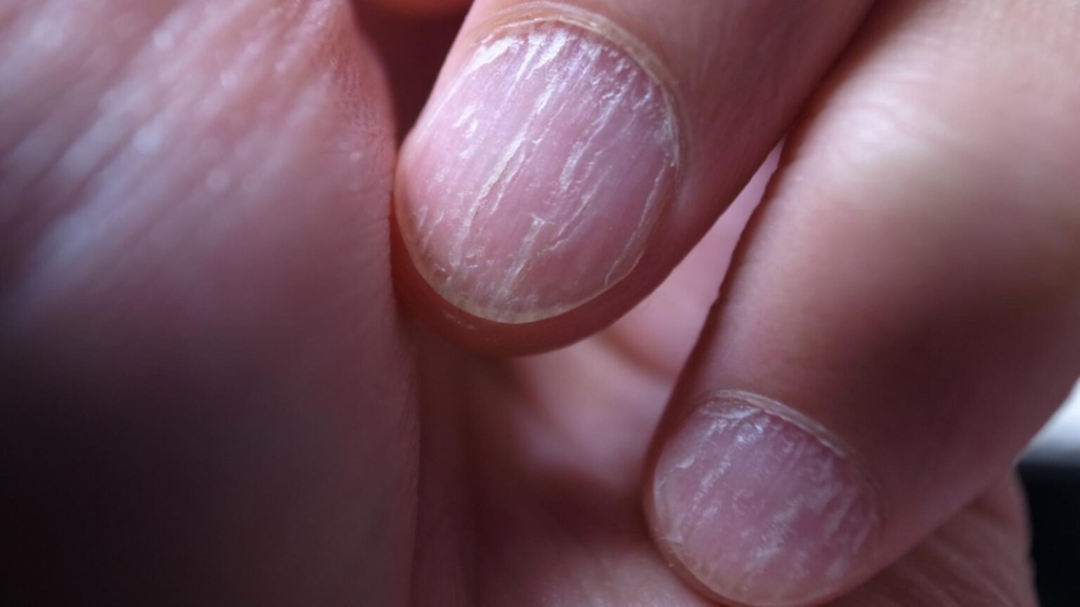 semnele de pe unghii care indica afectiunile de care suferi ce boli poti avea daca ai pete albe pe unghii 68e742db06b19