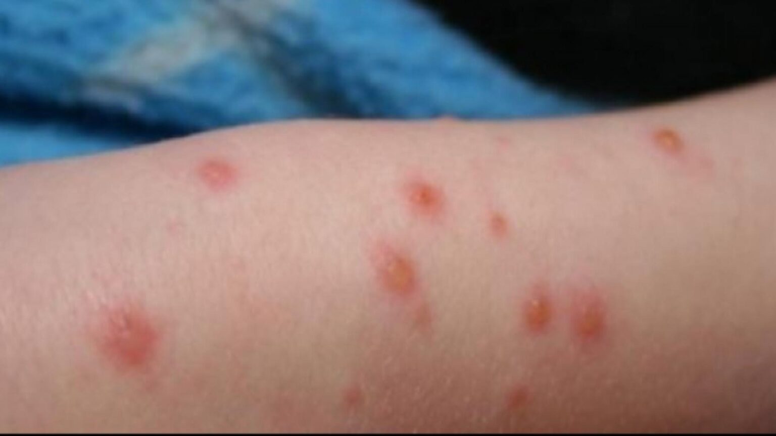 rujeola revine in forta crestere alarmanta intr o tara ue autoritatile dau vina pe romania si maroc 693d8675e5be6