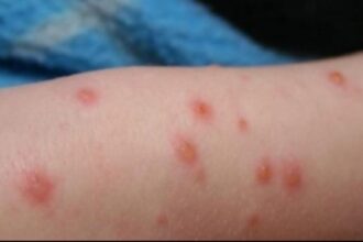 rujeola revine in forta crestere alarmanta intr o tara ue autoritatile dau vina pe romania si maroc 693d8675e5be6